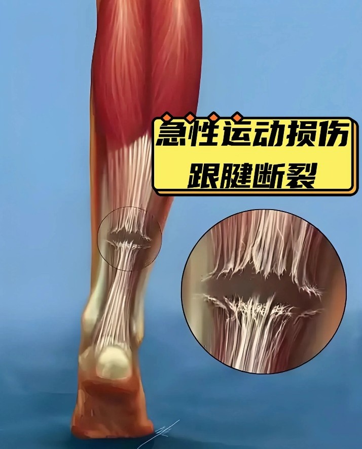 乐鱼体育官方入口-10个月康复已算快！跟腱撕裂为什么是竞技体育的“阿喀琉斯之踵”